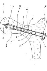 Verbindungselement für Knochenfrakturen, Zeichnung aus Patentschrift DE1965350
