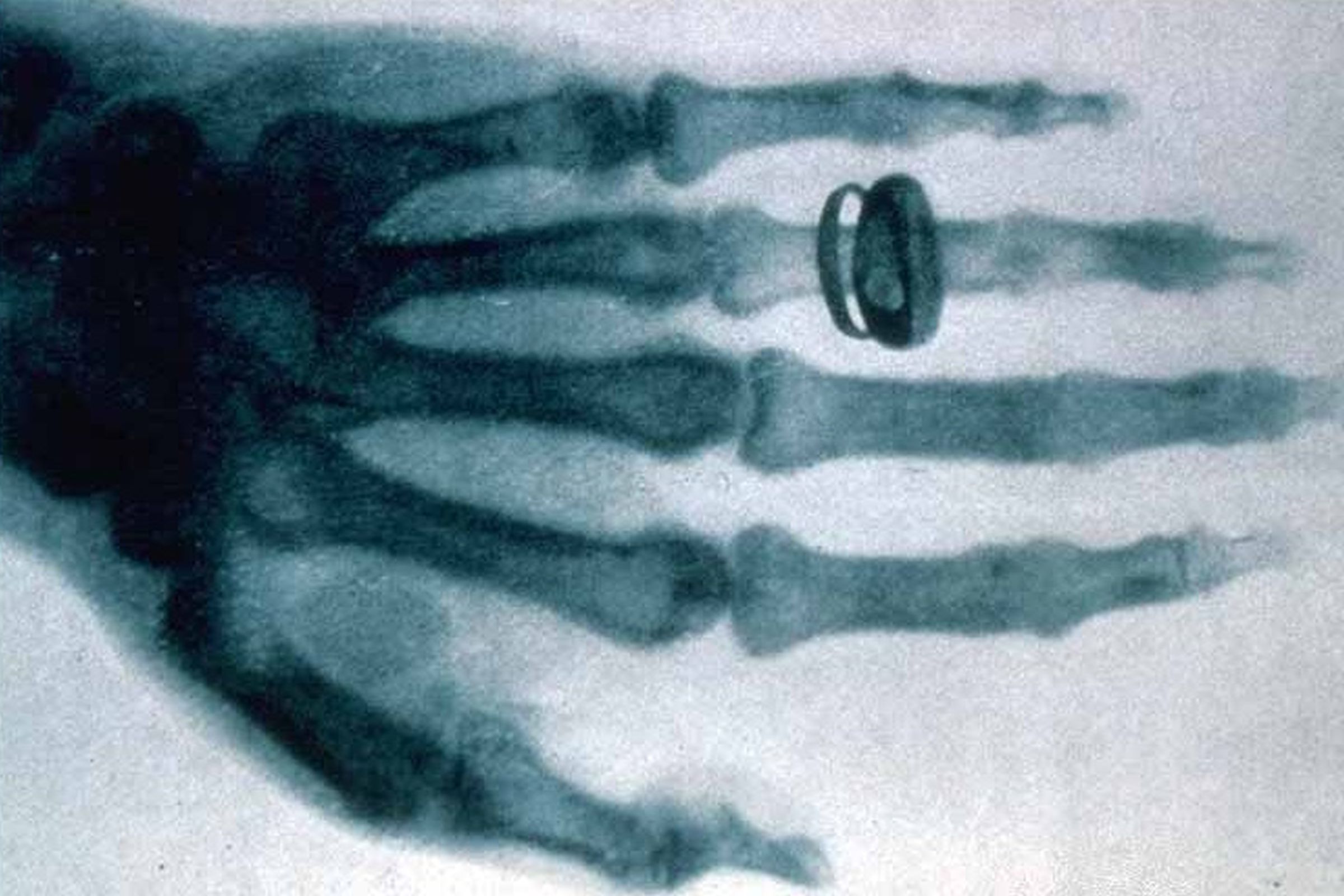 Röntgen-Bild der Hand von Alber von Kölliker von Wilhelm Röntgen